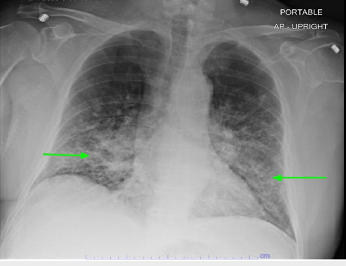 What is patchy airspace disease