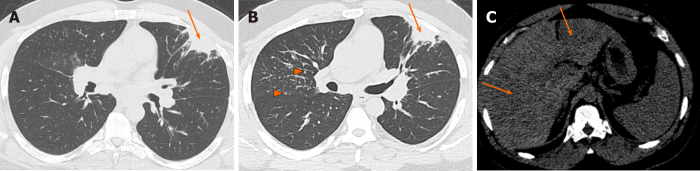 Airspace disease lung pleura chest wall aspiration distress radiograph frontal newborn meconium patchy diffuse fetal shows figure